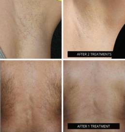 Bloom - Laser Hair Removal - Before and Afters